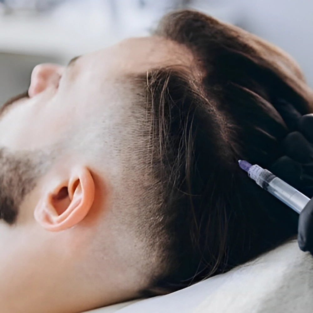 خداحافظی با کچلی با کوکتل مو فیوژن